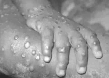 JUST IN| Nigeria confirms 66 suspected Monkeypox cases, one Death