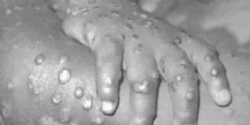 JUST IN| Nigeria confirms 66 suspected Monkeypox cases, one Death
