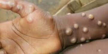 Monkeypox: FG directs Hunters, Bushmeat sellers to discontinue Business