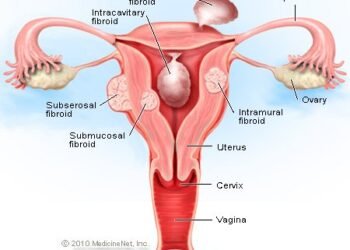 Expert: How to Prevent Death from Fibroids