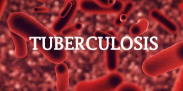 Tuberculosis: Ignorance, poor environment leading cause of disease – Expert