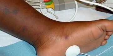 Meningitis: Avoid Overcrowded, Poorly Ventilated Areas, Doctor Cautions Nigerians