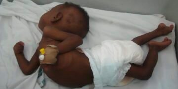 Meningitis